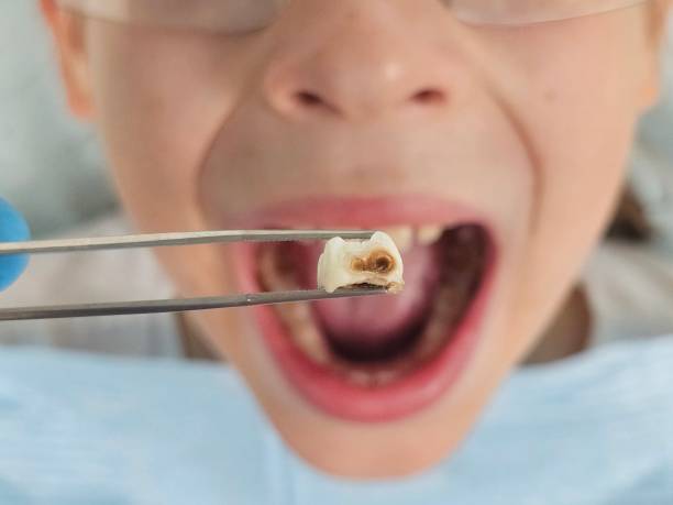 Best Emergency Wisdom Teeth Removal in Jasmine Estates, FL